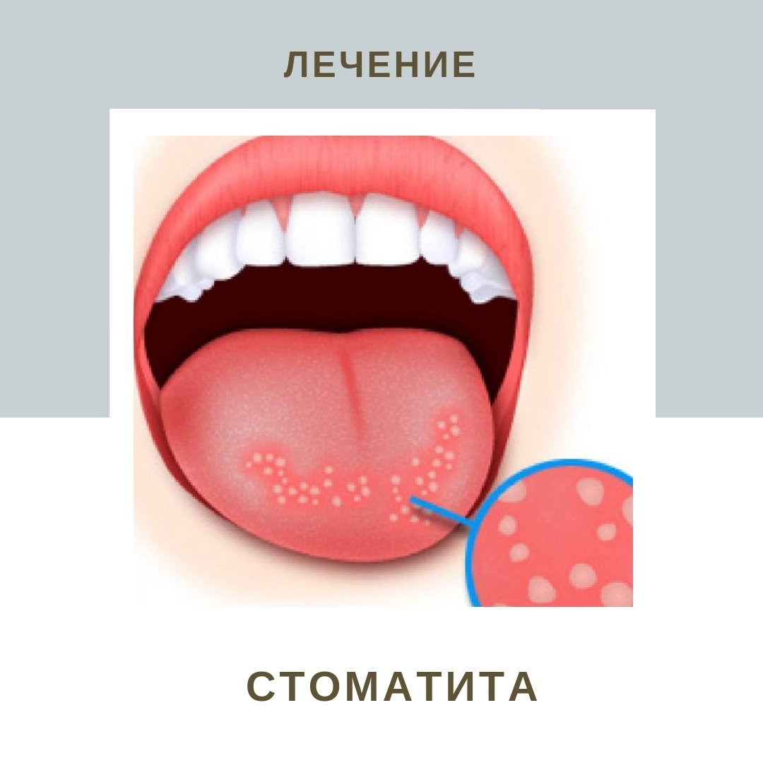 Стоматит картинки